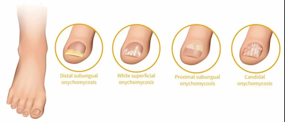 vrste_glivicne_okuzbe